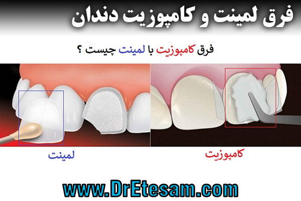فرق لمینت و کامپوزیت دندان
