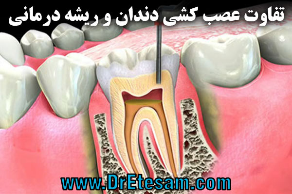 تفاوت عصب کشی دندان و ریشه درمانی