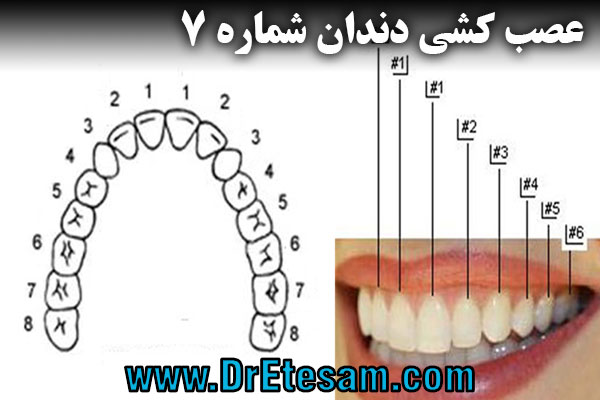 عصب کشی دندان شماره 7