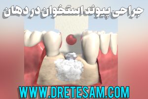 جراحی پيوند استخوان در دهان
